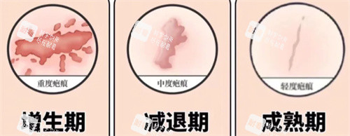 开眼角术后疤痕期.jpg