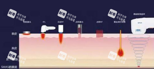超声炮改善展示图照片.jpg