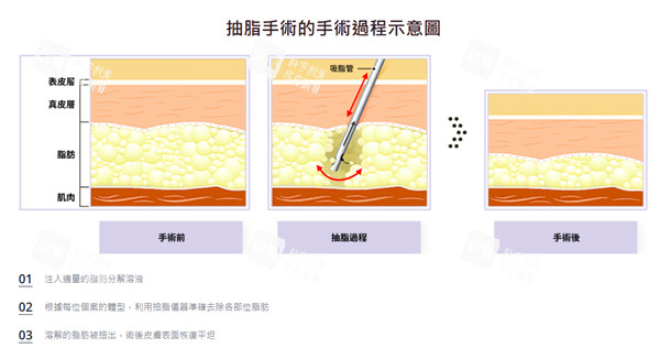 吸脂手术过程示意.jpg