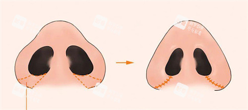鼻孔缩小手术.jpg