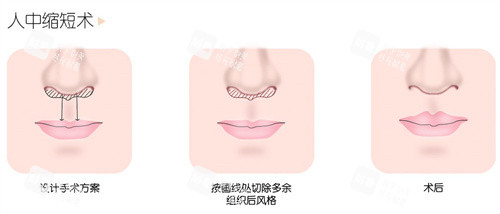 人中缩短术.jpg 人中缩短术.jpg