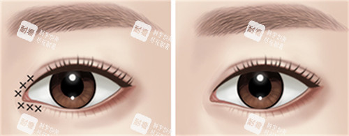 开眼角手术前后对比图.jpg 开眼角手术前后对比图.jpg