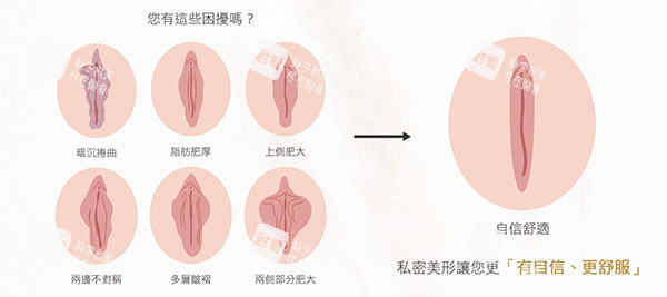 外阴阴唇整形前后变化.jpg