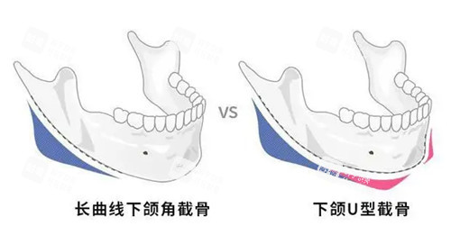 下颌角截骨位置示意图.jpg