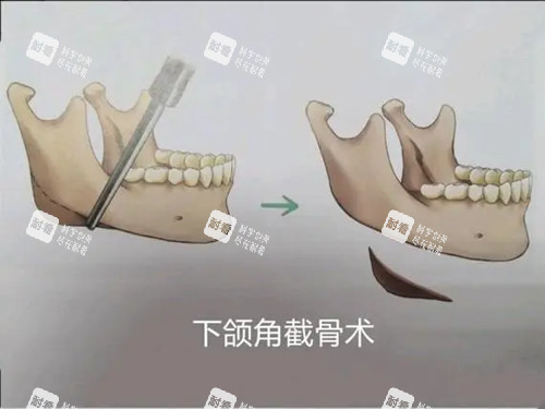 下颌角截骨术卡通示意图.jpg