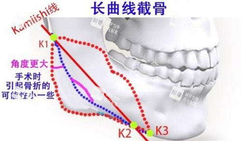 下颌角长曲线截骨的截骨位置.jpg 下颌角长曲线截骨的截骨位置.jpg