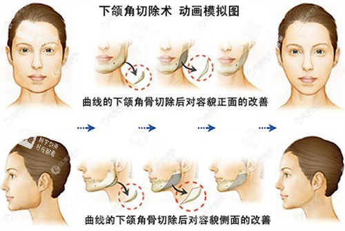 下颌角切除术动画模拟图.jpg