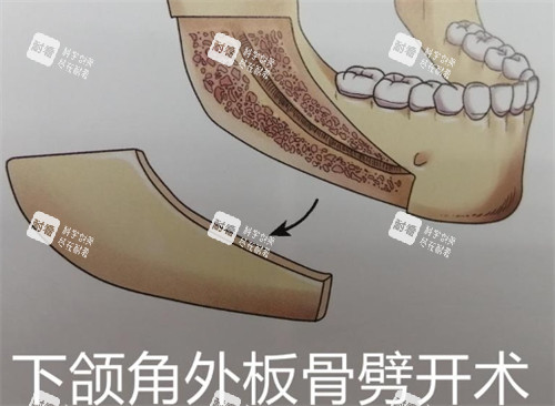 下颌角外板劈开术.jpg