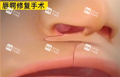 唇裂修复手术即刻形状.jpg 唇裂修复手术即刻形状.jpg