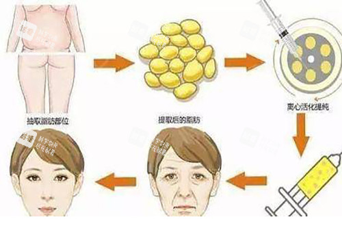 面部脂肪填充过程示意图.jpg 面部脂肪填充过程示意图.jpg
