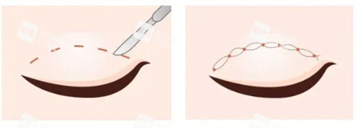 双眼皮切开vs双眼皮埋线.jpg