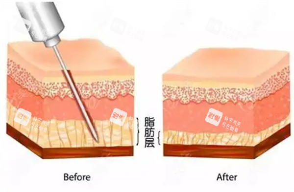 吸脂手术操作.jpg