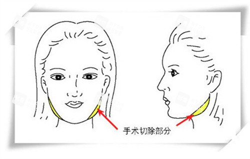 下颌角截骨手术.jpg