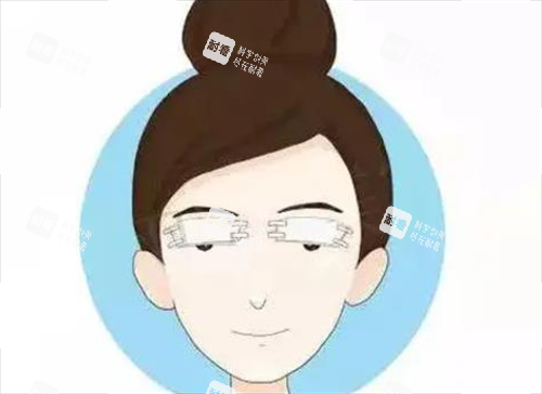 双眼皮术后.png