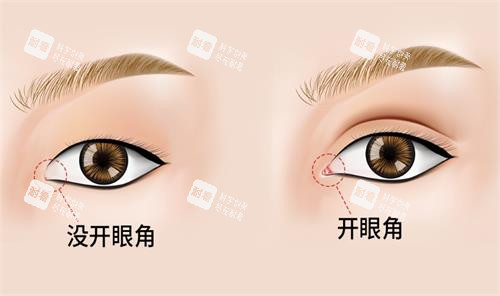开眼角前后对比图.png
