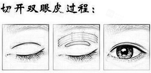切开双眼皮.jpg