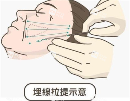 埋线提升面部的操作过程.jpg