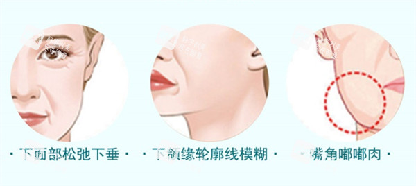 适合埋线提升的情况.jpg