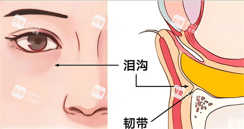 泪沟填充卡通图.jpg 泪沟填充卡通图.jpg
