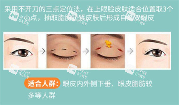 三点双眼皮解析.jpg