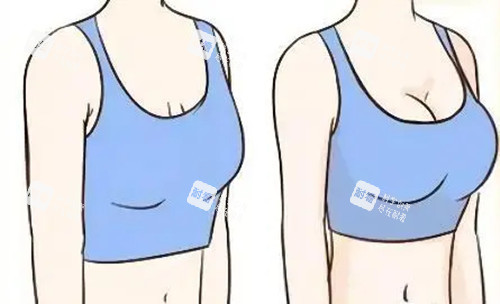 胸部整形前后对比卡通示意图.jpg