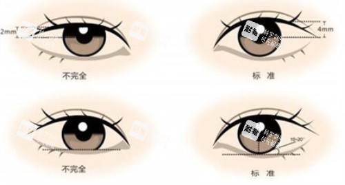 双眼皮示意图.JPG