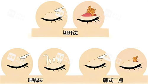 双眼皮方法对比图.jpg