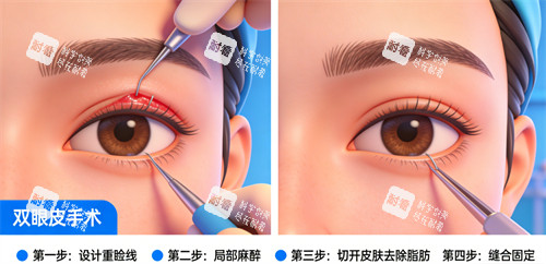 双眼皮手术过程解析.jpg