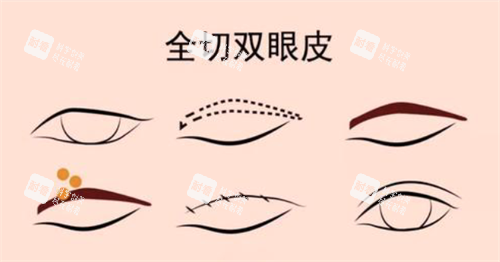 全切双眼皮经过.png