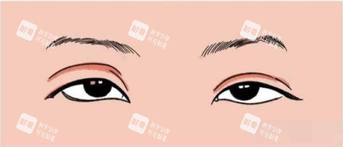 双眼皮过宽.JPG 双眼皮过宽.JPG