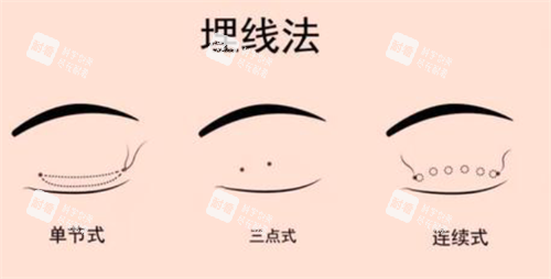 埋线双眼皮经过.png