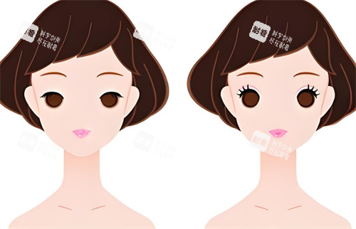双眼皮前后对比图.jpg