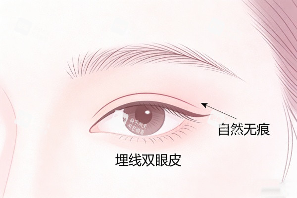埋线双眼皮卡通图一览.jpg