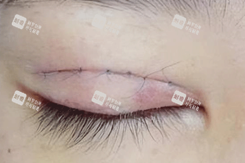 双眼皮疤痕明显照片.png