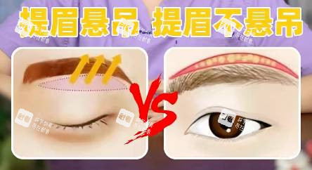 cfs悬吊术示意图.jpg cfs悬吊术示意图.jpg