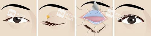 CFS悬吊术手术过程.jpg CFS悬吊术手术过程.jpg
