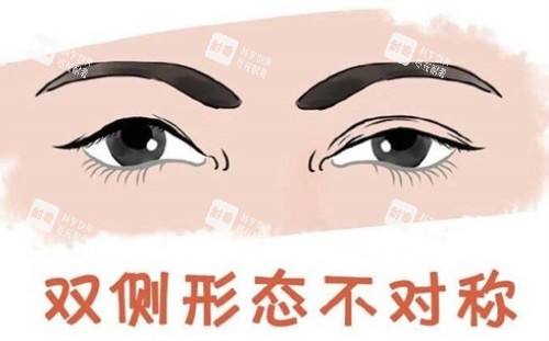双眼皮形态不对称.JPG 双眼皮形态不对称.JPG