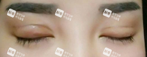 双眼皮失败照片.jpg 双眼皮失败照片.jpg