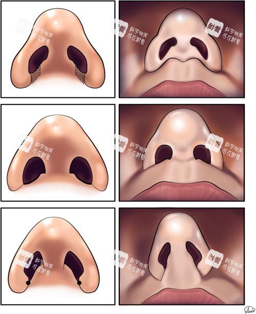 鼻整形的对比.jpg