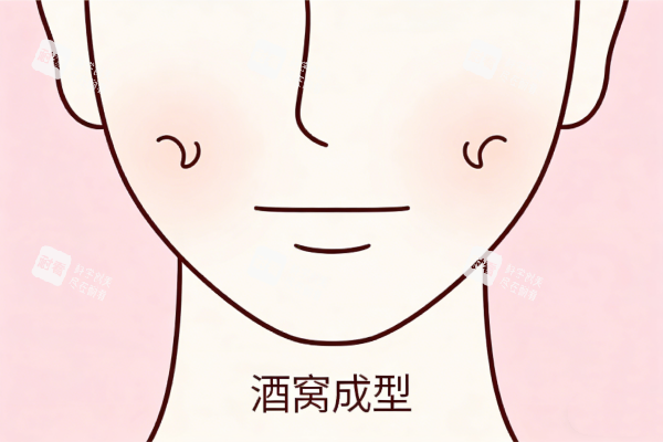 酒窝成形术卡通图展示.png
