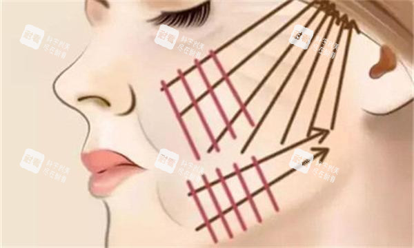 面部拉皮划线图.jpg