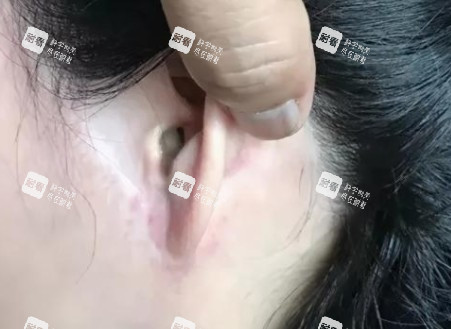 拉皮手术疤痕图.jpg