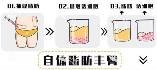 自体脂肪移植过程.jpg