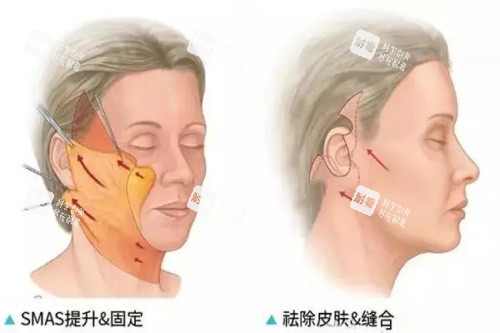 拉皮手术.JPG