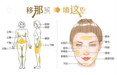 自体脂肪面部填充步骤图.png 自体脂肪面部填充步骤图.png