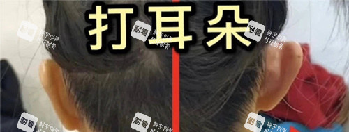 精灵耳注射图.jpg 精灵耳注射图.jpg