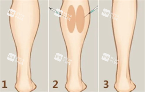 瘦腿注射前后变化.jpg 瘦腿注射前后变化.jpg