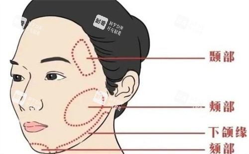 面部提升可以提升的区域.jpg 面部提升可以提升的区域.jpg