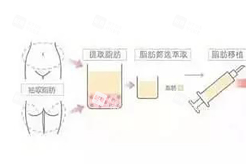 脂肪填充过程示意图.jpg 脂肪填充过程示意图.jpg