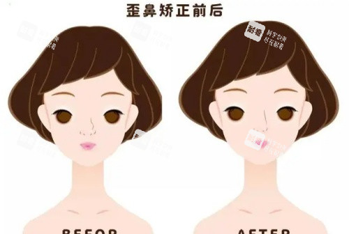 假体鼻子歪斜矫正前后示意图.jpg